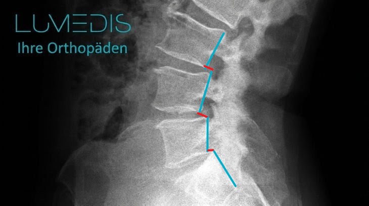 Röntgenbild der LWS mit Wirbelgleiten (Meyerding 1°)