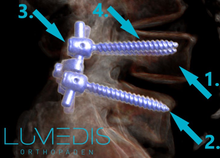 Spondylodese der LWS