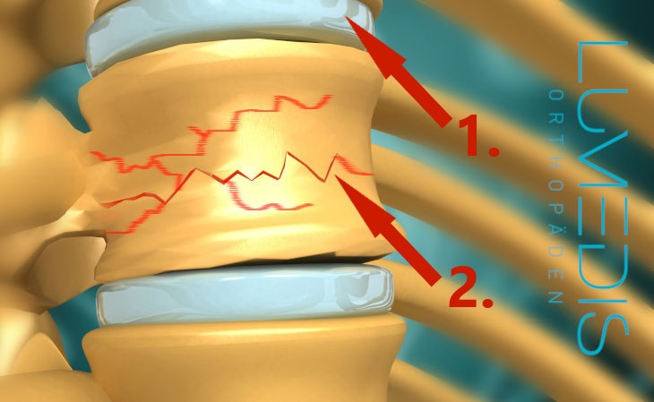 Bruch eines Wirbels