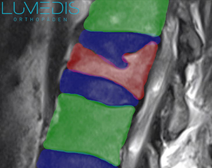 Wirbelkörperbruch der Brustwirbelsäule
