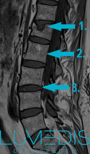 Wirbelkörperbruch L1