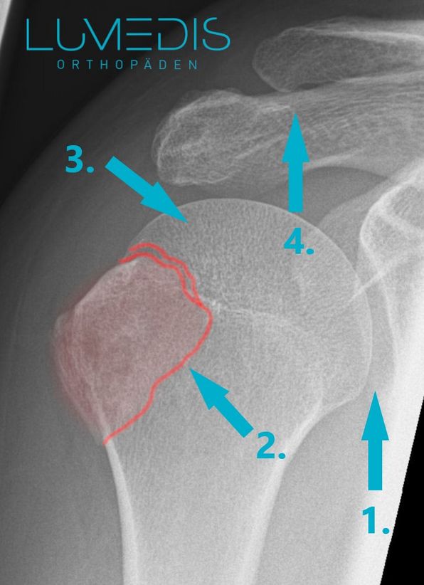 Röntgenbild einer Tuberculum majus Fraktur rechts