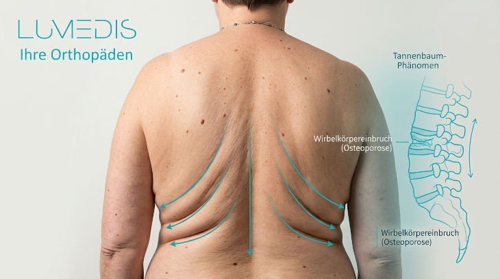 Abbildung eines Tannenbaumphänomens