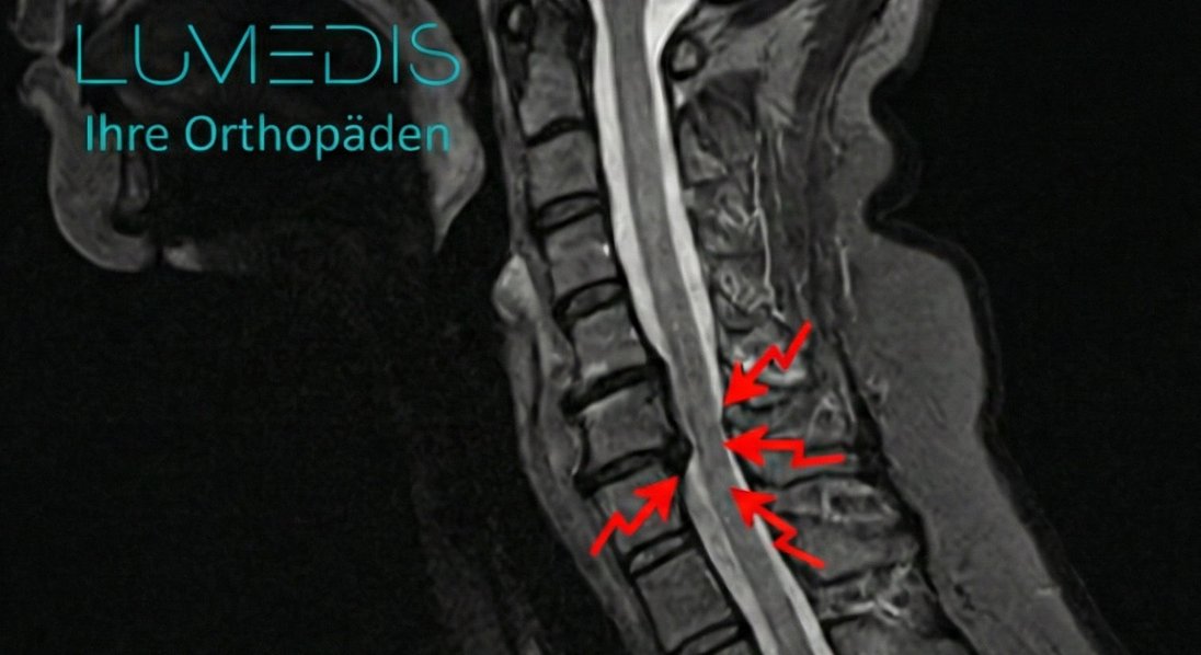 MRT einer Spinalkanalstenose der HWS C5/C6