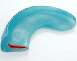 Horizontalriss des Meniskus