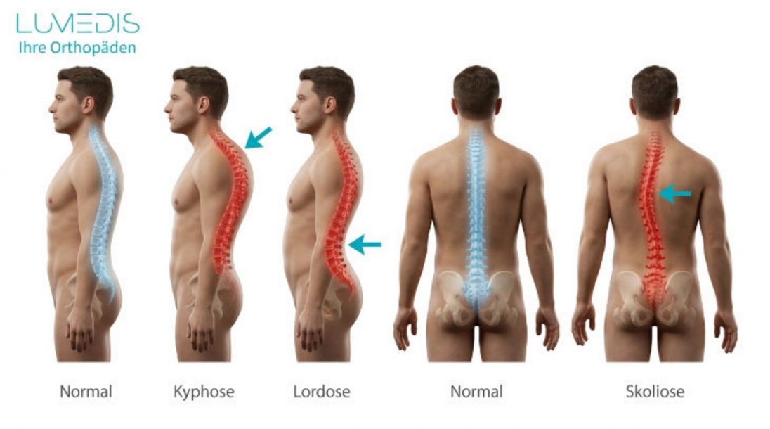 Fehlhaltungen des Rückens