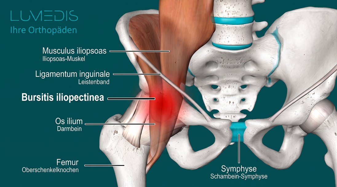 Abbildung einer Bursitis iliopectinea