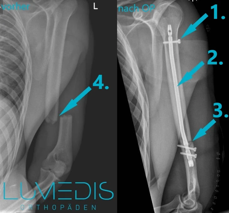 Röntgenbild Oberarmbruch vorher und nachher