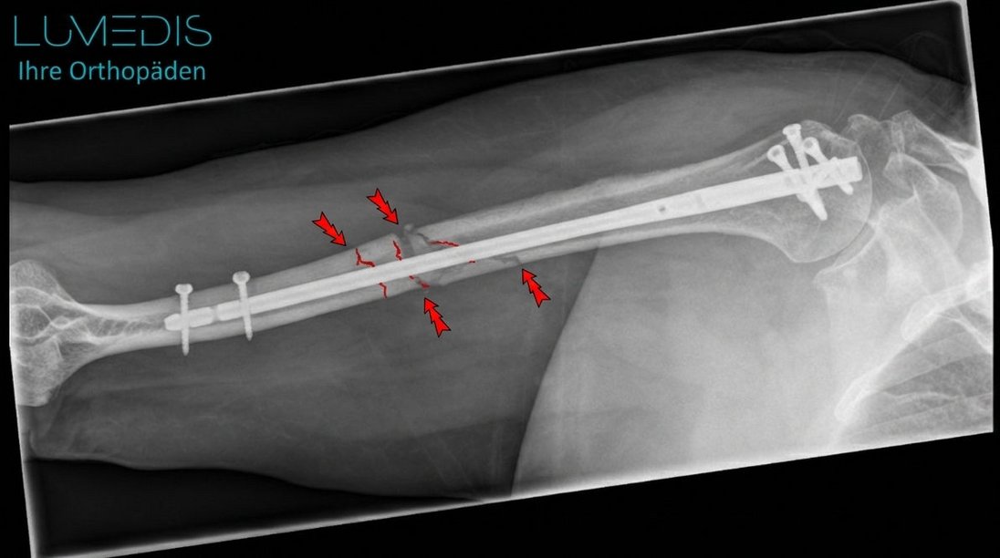 Bruch des Oberarms, der mit einem Nagel versorgt wurde