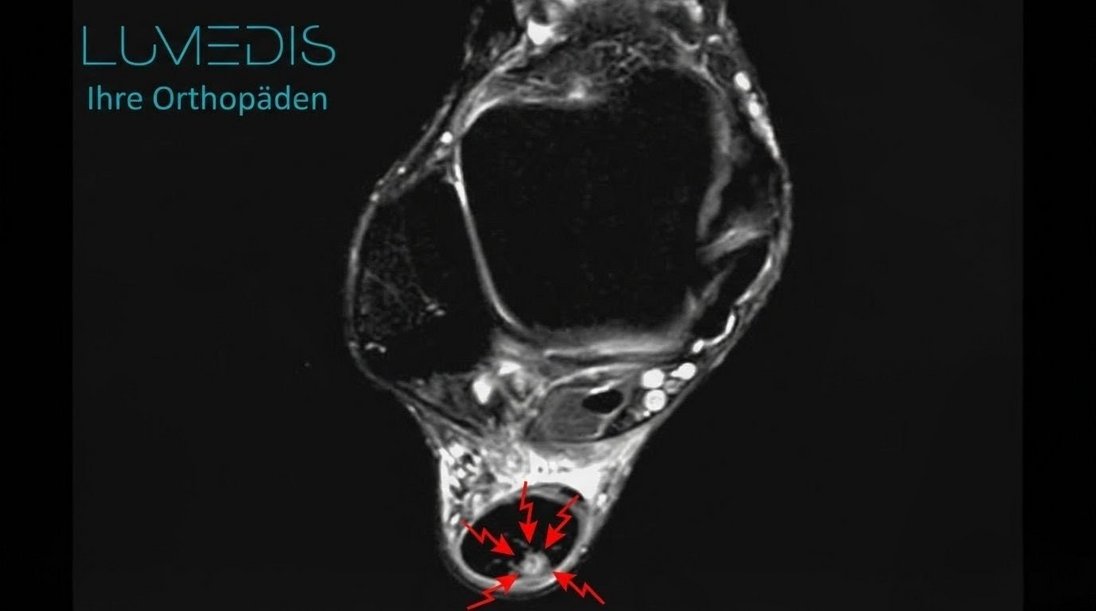 MRT einer angerissenen Achillessehne