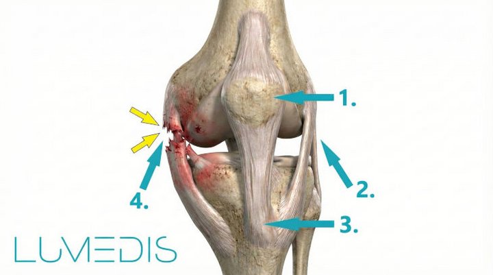 Innenbandriss Knie Innenbandriss Knie