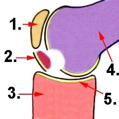 Osteochondrosis dissecans